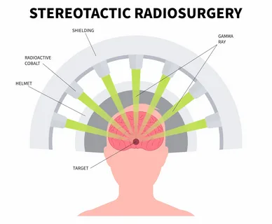 Radiosurgery